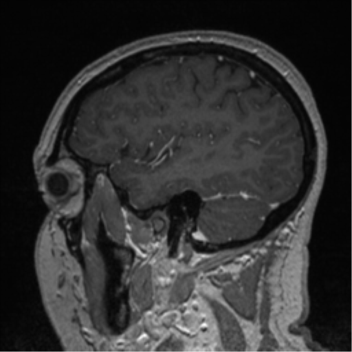 Cerebral cavernoma and development venous anomaly (Radiopaedia 37603-39482 Sagittal T1 C+ 25).png