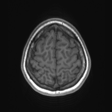 Cerebral cavernous venous malformation (Radiopaedia 70008-80021 Axial T1 78).jpg