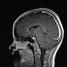 Cerebral cavernous venous malformation (Radiopaedia 70008-80021 Sagittal T1 C+ 39).jpg