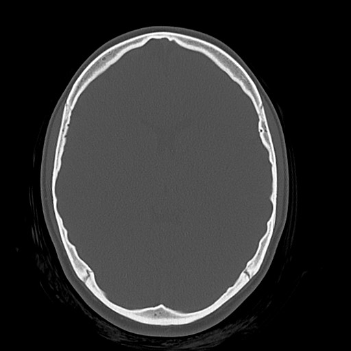 Cerebral cavernous venous malformation (Radiopaedia 70008-80022 Axial bone window 24).jpg