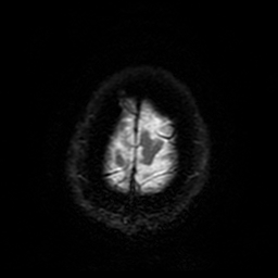 Cerebral cavernous venous malformation (Zabramski type II) (Radiopaedia 85511-101198 Axial DWI 95).jpg