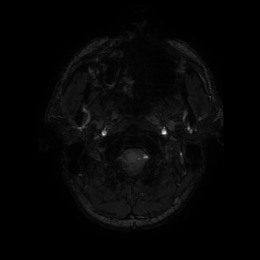 File:Cerebral cavernous venous malformation (Zabramski type II) (Radiopaedia 85511-101198 Axial SWI 8).jpg