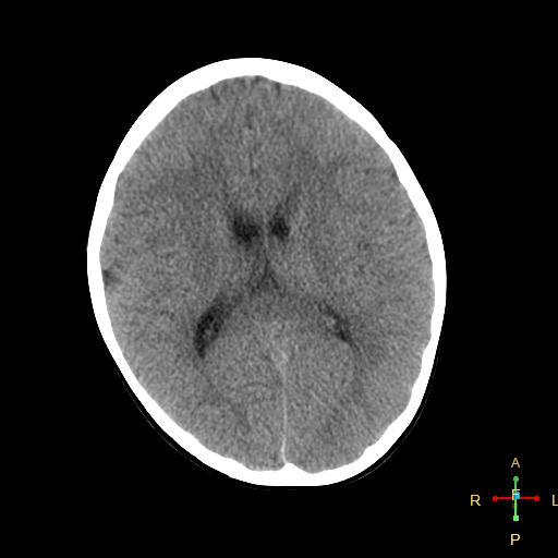 File:Cerebral contusion (Radiopaedia 48869-53911 Axial non-contrast 11).jpg