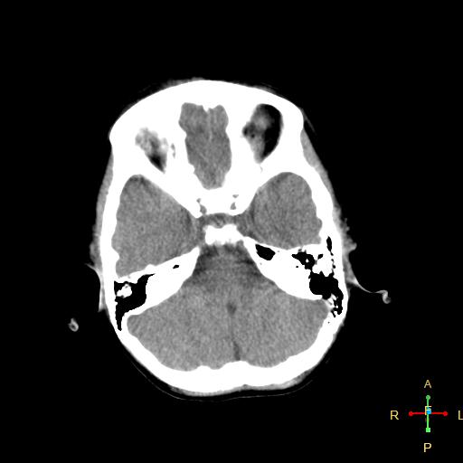 File:Cerebral contusion (Radiopaedia 48869-53911 Axial non-contrast 3).jpg