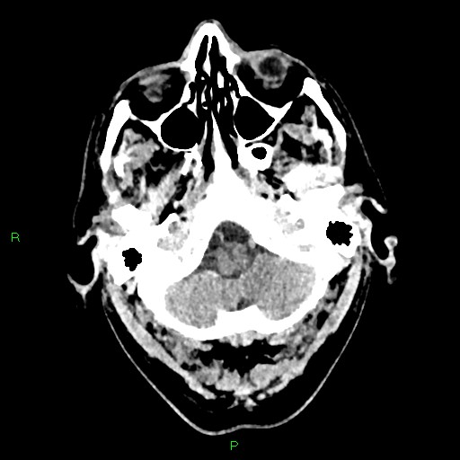File:Cerebral contusions (Radiopaedia 33868-35039 Axial non-contrast 23).jpg