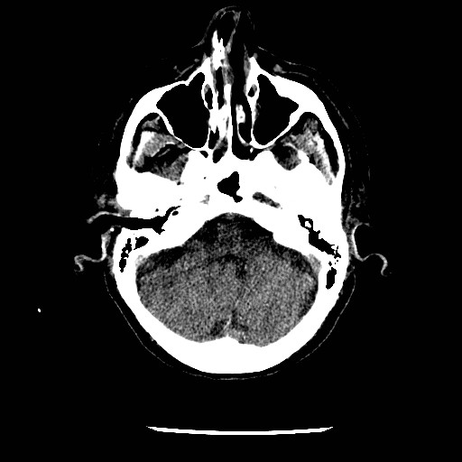 File:Cerebral edema (evolution in time) (Radiopaedia 19418-19441 non-contrast 25).jpg