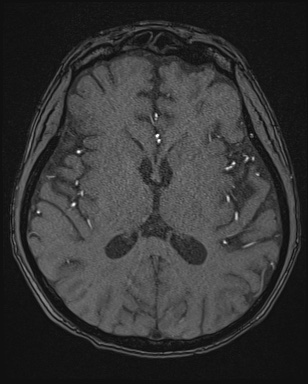 Cerebral embolic infarcts (embolic shower) (Radiopaedia 72391-82921 Axial MRA 101).jpg