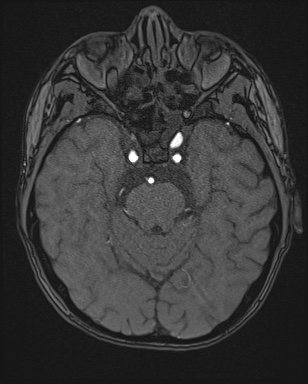 File:Cerebral embolic infarcts (embolic shower) (Radiopaedia 72391-82921 Axial MRA 46).jpg