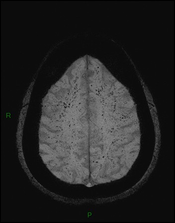 File:Cerebral fat embolism (Radiopaedia 35022-36525 Axial SWI 45).jpg