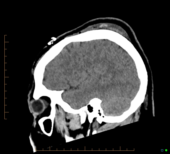 Cerebral fat embolism (Radiopaedia 85521-101224 C 40).jpg