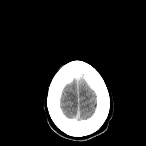 File:Cerebral hemorrhagic contusions- temporal evolution (Radiopaedia 40224-42753 Axial non-contrast 31).png