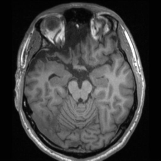 Cerebral hemorrhagic contusions- temporal evolution (Radiopaedia 40224-42757 Axial T1 29).png