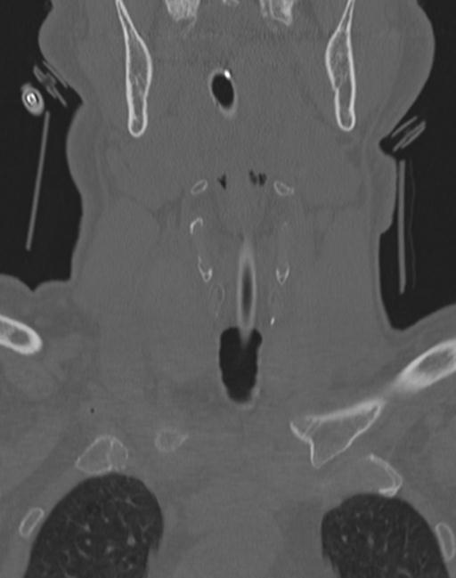 Cerebral hemorrhagic contusions and cervical spine fractures (Radiopaedia 32865-33841 Coronal bone window 3).jpg
