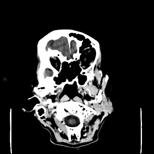 Cerebral metastases - breast primary (Radiopaedia 77653-89857 Axial C+ delayed 15).jpg