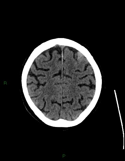 Cerebral metastases - ependymal and parenchymal (Radiopaedia 79877-93131 Axial non-contrast 62).jpg