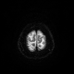 File:Cerebral metastases - melanoma (Radiopaedia 80972-94522 Axial DWI 92).jpg