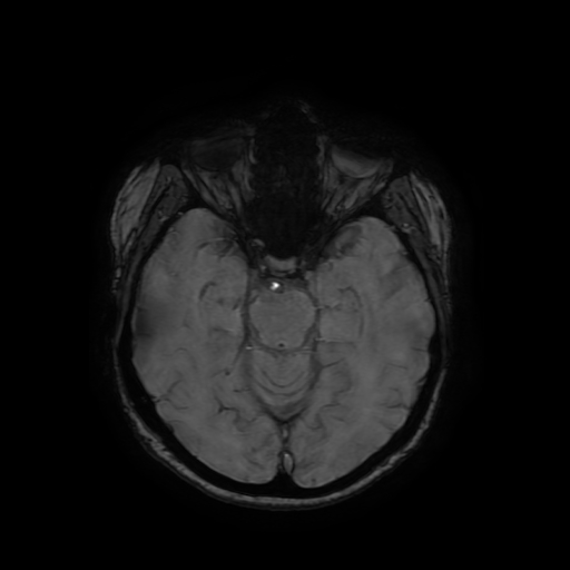 Cerebral metastases - melanoma (Radiopaedia 80972-94522 Axial SWI 38).jpg