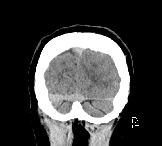 Cerebral metastases - testicular choriocarcinoma (Radiopaedia 84486-99855 Coronal C+ delayed 57).jpg