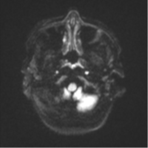 Cerebral metastases mimicking abscesses (Radiopaedia 45841-50131 Axial DWI 32).png