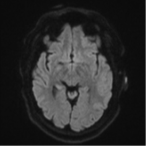 Cerebral metastases mimicking multifocal glioblastoma (Radiopaedia 50843-56353 Axial DWI 40).png