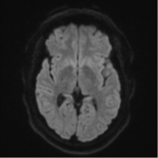 Cerebral metastases mimicking multifocal glioblastoma (Radiopaedia 50843-56353 Axial DWI 41).png
