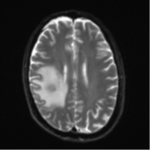 Cerebral metastasis - melanoma (Radiopaedia 54718-60954 Axial DWI 20).png
