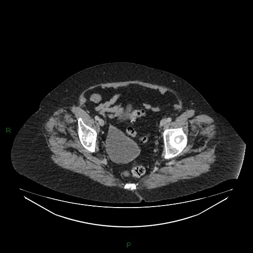 File:Cerebral metastasis from renal cell carcinoma (Radiopaedia 82306-96378 A 170).jpg