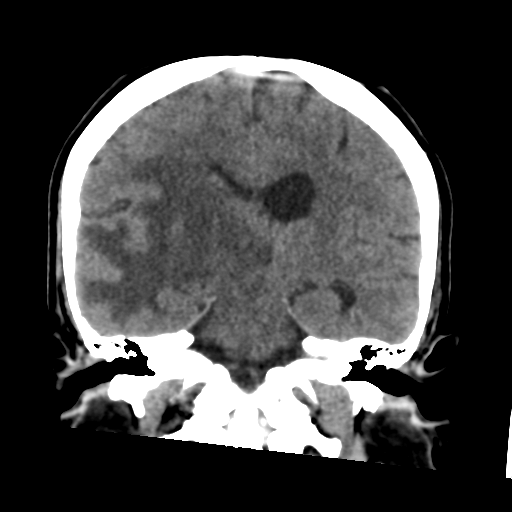 Cerebral metastasis to basal ganglia (Radiopaedia 81568-95412 Coronal non-contrast 39).png