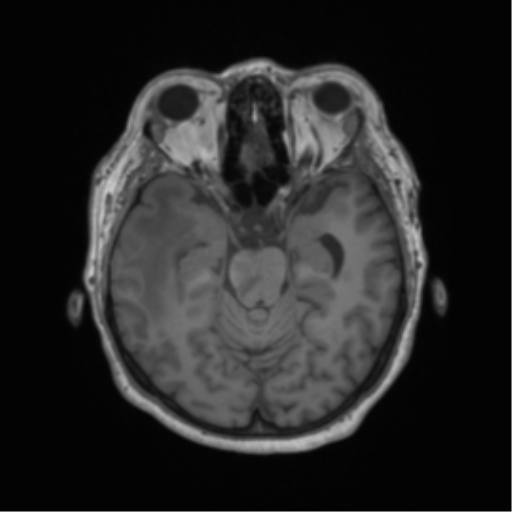 Cerebral metastasis to basal ganglia (Radiopaedia 81568-95413 Axial T1 25).png