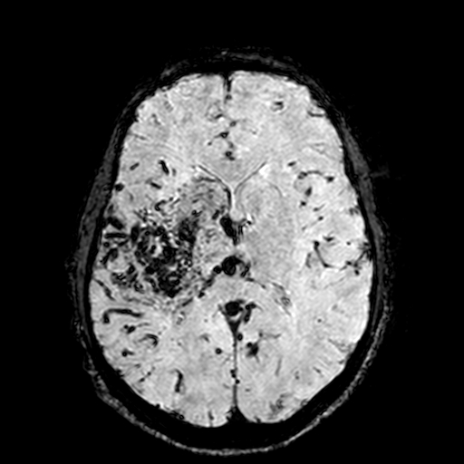 Cerebral parenchymal arteriovenous malformation (Radiopaedia 27280-27456 Axial SWI 64).jpg