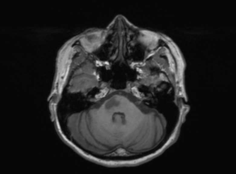 Cerebral ring enhancing lesions - cerebral metastases (Radiopaedia 44922-48817 Axial T1 299).jpg