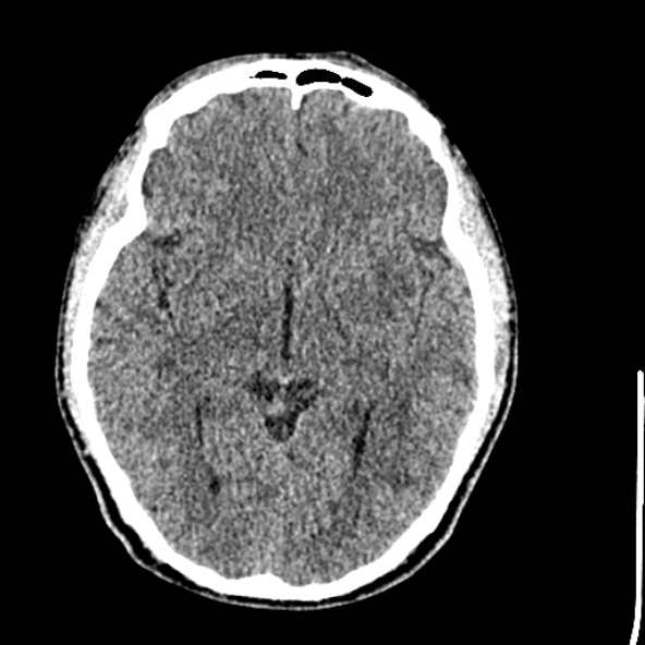 Cerebral toxoplasmosis (Radiopaedia 53993-60131 Axial non-contrast 38).jpg