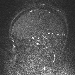 Cerebral tuberculosis with dural sinus invasion (Radiopaedia 60353-68090 Sagittal MRV 61).jpg