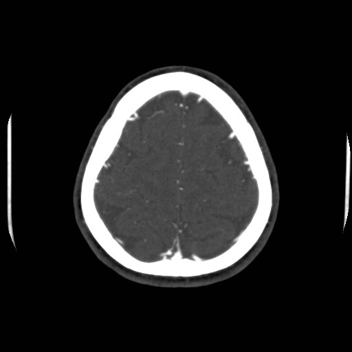 Cerebral venous sinus thrombosis (Radiopaedia 40619-43227 A 195).jpg