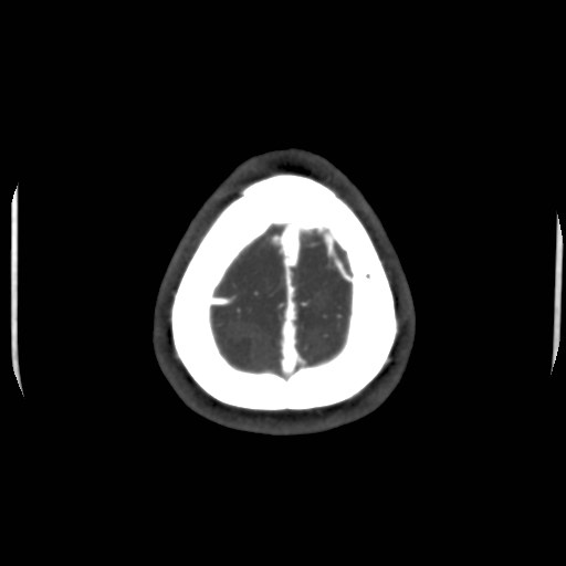 Cerebral venous sinus thrombosis (Radiopaedia 40619-43227 A 215).jpg