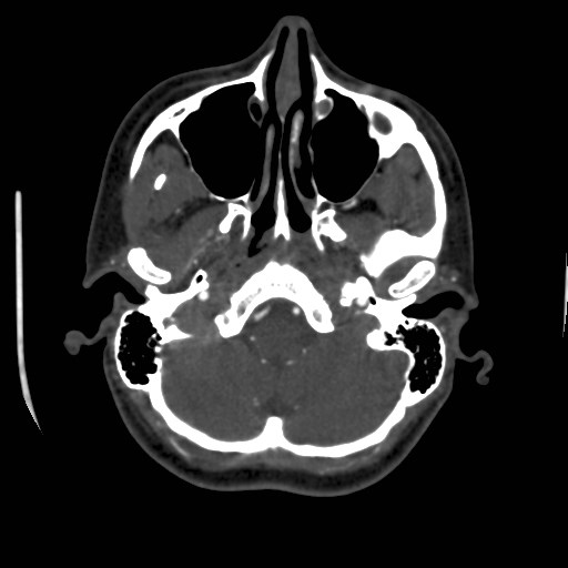 Cerebral venous sinus thrombosis (Radiopaedia 40619-43227 A 37).jpg