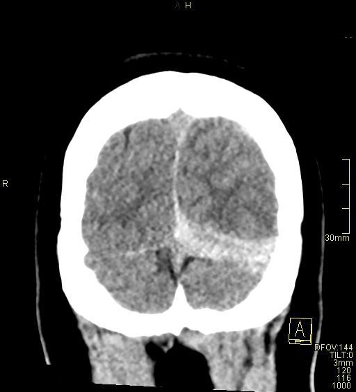 Cerebral venous sinus thrombosis (Radiopaedia 91329-108965 Coronal non-contrast 51).jpg