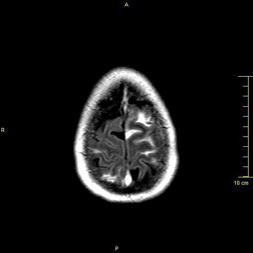 File:Cerebral venous thrombosis (Radiopaedia 23288-23351 Axial FLAIR 20).JPG