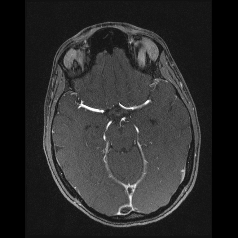 Cerebral venous thrombosis (Radiopaedia 45678-49854 Axial MRV 27).jpg
