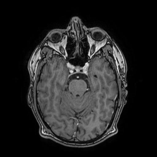 File:Cerebral venous thrombosis with secondary intracranial hypertension (Radiopaedia 89842-106957 Axial T1 C+ 71).jpg
