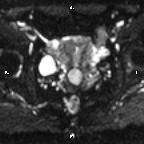 Cervical adenocarcinoma (Radiopaedia 65011-73985 Axial DWI 46).jpg
