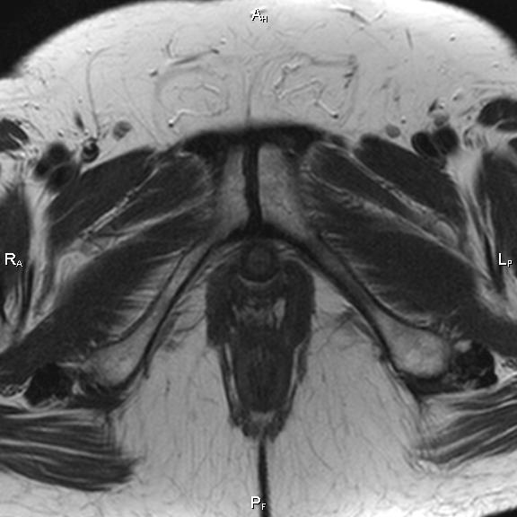 File:Cervical adenocarcinoma (Radiopaedia 65011-73985 Axial T2 7).jpg