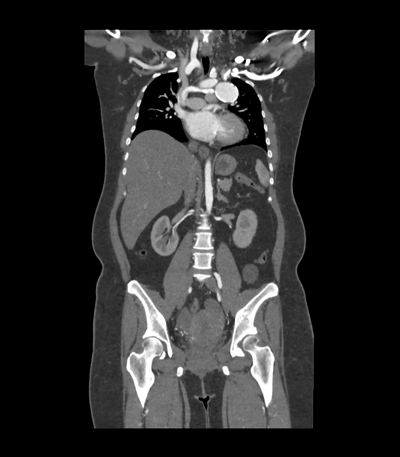 Cervical aortic arch with coarctation and aneurysms (Radiopaedia 44035-47552 C 23).jpg