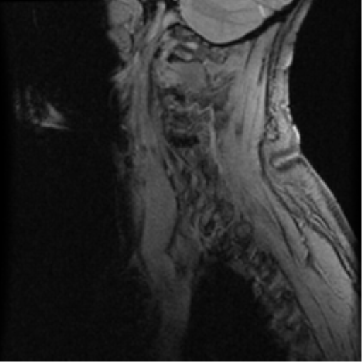 File:Cervical canal stenosis with cord compression (Radiopaedia 34114-35374 D 19).png