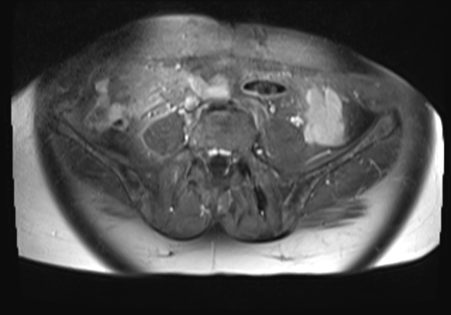 File:Cervical carcinoma (Radiopaedia 88312-104943 Axial T1 C+ fat sat 2).jpg