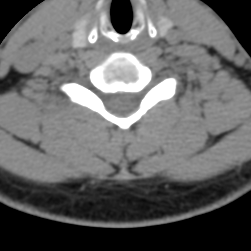 Cervical schwannoma (Radiopaedia 57979-64974 Axial non-contrast 45).png