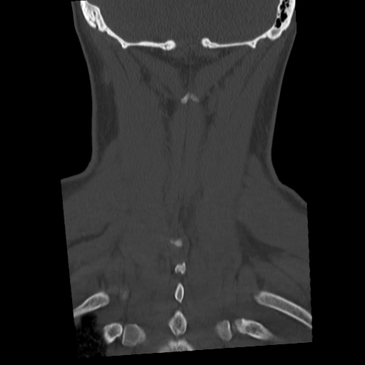 Cervical schwannoma (Radiopaedia 57979-64974 Coronal bone window 47).png