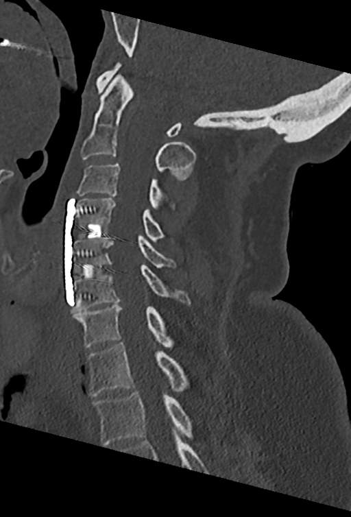 Cervical spine ACDF loosening (Radiopaedia 48998-54070 Sagittal bone window 43).png