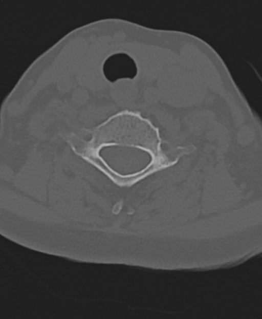 Cervical spine ACDF loosening (Radiopaedia 48998-54071 Axial bone window 43).png