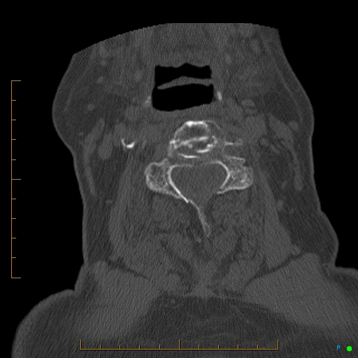 File:Cervical spine fracture - ankylosing spondylitis (Radiopaedia 76835-88706 Axial bone window 102).jpg